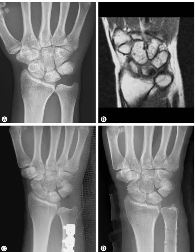 Fig. 2. A 45-year-old female patient complained of right wrist ulnar-side pain. (A) Radiograph shows positive ulnar variance (1.4 mm) and cystic change of the lunate
