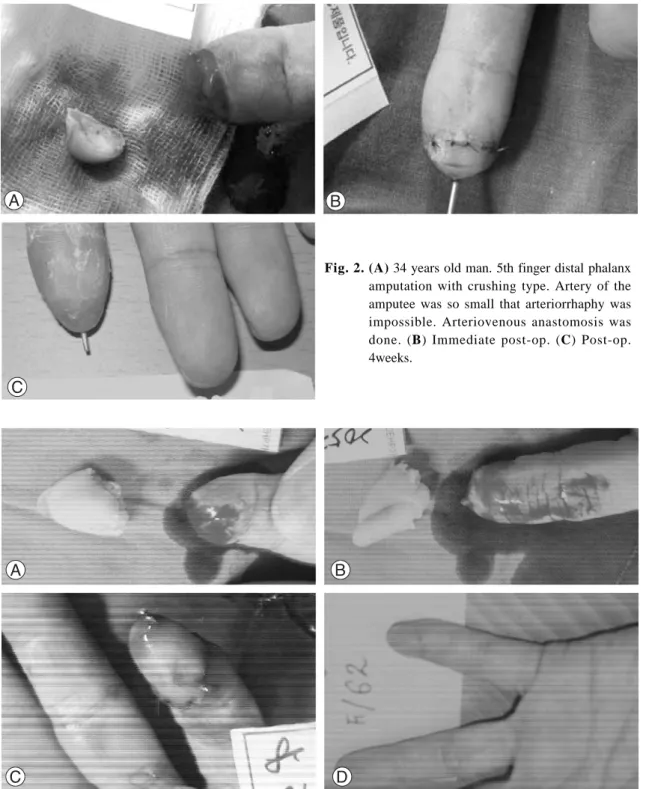 Fig. 2. (A) 34 years old man. 5th finger distal phalanx amputation with crushing type