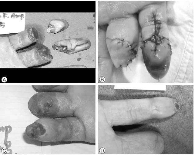 Fig. 4. (A) 38 years old man. 5th finger distal phalanx amputation with avulsion type
