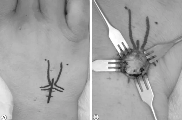 Fig. 2. Surgical approach of donor site. (A) Surface landmarks are marked and skin incision of about 3 cm length is applied to harvest the osteochondral autograft from hamate