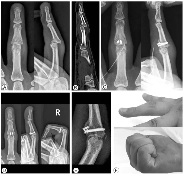 Fig. 4. Case 1. (A) (B) Preoperative simple radiographs and computed tomograph image show comminuted volar lip fracture of the middle phalangeal base with subluxation of the proximal interphalangeal joint