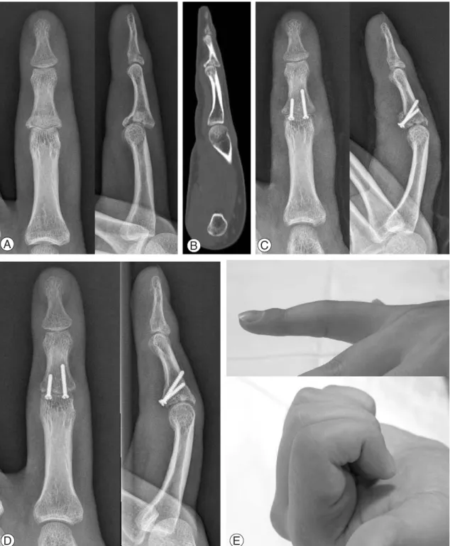 Fig. 5. Case 2. (A, B) Preoperative simple radiographs and computed tomography image show depression and com- com-minution of the joint surface with subluxation of the proximal interphalangeal joint