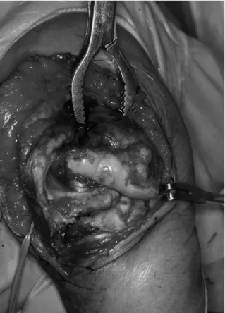 Fig. 3. After excision of the radial head, elbow joint sur- sur-face is exposed by supinating the forearm.