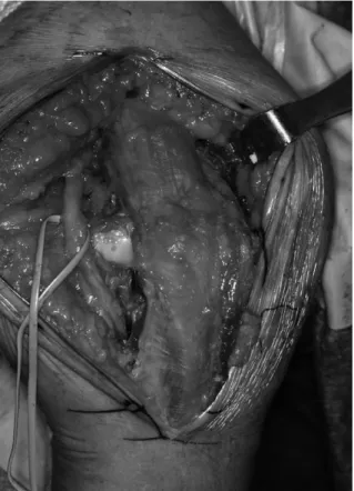 Fig. 4. Components are articulated and engaged by insert- insert-ing the axis pin through the medial window.