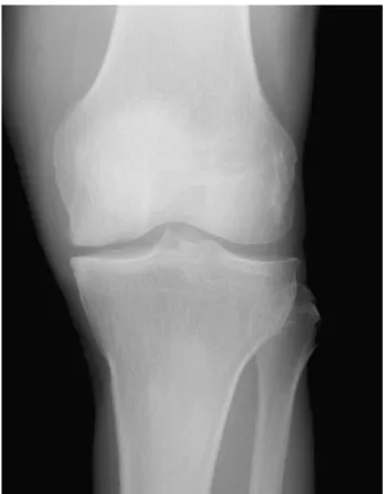 Fig. 6. Plain x-ray. 6 months after meniscal retightening.