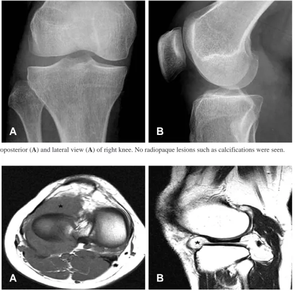 Fig. 2. (A) On T1 weighted image, there are the lesions with intermediate signal intensity around right lateral meniscus (star)
