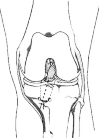 Fig. 5. A lateral end of wire which inserted in the ACL is passed and pulled distally, leading end of the inserted wire through the lateral bony tunnels.