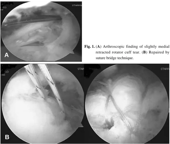 Fig. 1. (A) Arthroscopic finding of slightly medial retracted rotator cuff tear. (B) Repaired by suture bridge technique.