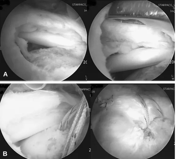 Fig. 2. (A) Arthroscopic finding of more medial retracted large rotator cuff tear. (B) Repaired by suture bridge technique.