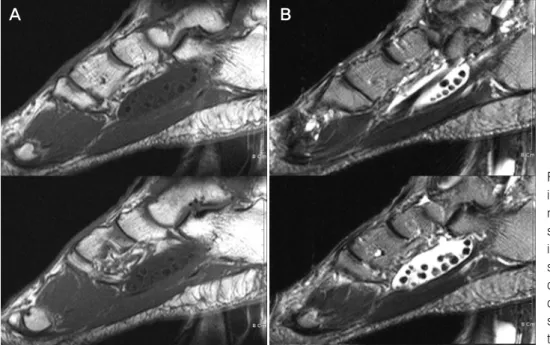 Figure  1.  Initial  radiographs  showing  multiple  calcificated  nodules  in  the  plantar  area  of  mid-foot.