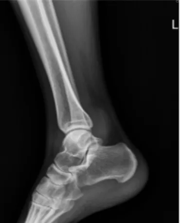 Figure  2.  Sagittal  MRI  of  Lt  ankle.  (A)  T1  weighted  image  shows  low  signal  intensity  mass  in  anterior  and  posterior  aspect  of  ankle  joint