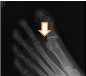 Figure  2.  A)  is  T1WI  coronal  view  in  foot,  B)  is  T2WI  coronal  view  in  foot