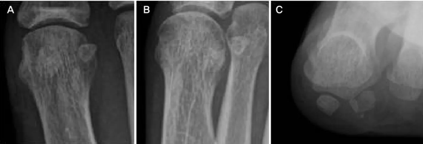Figure  4.  AP,  oblique  and  sesamoid  radiographs  of  foot  show  some  sclerosis  and  fragmentation  of  the  lateral  sesamoid  bone