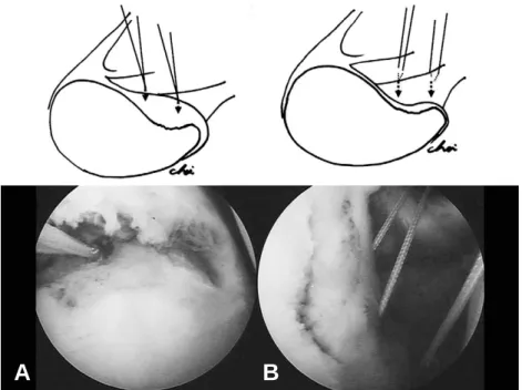 Fig. 1. (A) Anchors were inserted in the medial edge of the prepared bony lesion or 1 cm from the medial side of the glenoid articular margin to provide a sufficient contact surface with the mobilized labrum