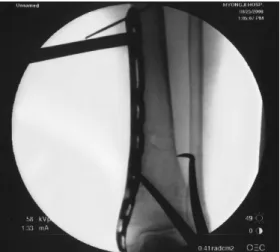 Figure  3.  Temporary  fixation  with  2  K-wire  and  reduction  clapm  after  close  reduction  is  satisfied.