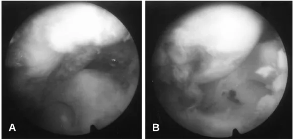Fig. 3. Magnetic resonance imaging revealed incarceration of the medial collateral and capsule in the medial compartment.