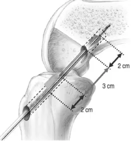 Fig. 1. This shows semitendinosus tendon harvesting technique with periosteum attachment.