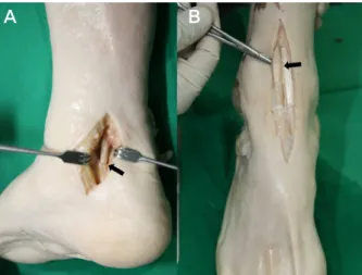 Figure  1.  (A)  Exposure  of  flexor  hallucis  longus  tendon  at  the  prox- prox-imal  border  of  fibro-osseous  tarsal  tunnel