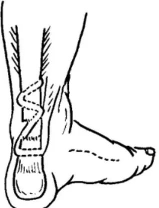 Figure  2.  Diagram  of  modified  FHL  tendon  transfer  showing  FHL  tendon  passing  through  the  distal  portion  of  the  ruptured  tendon  instead  of  the  drilled  hole  made  on  the  calcaneus.