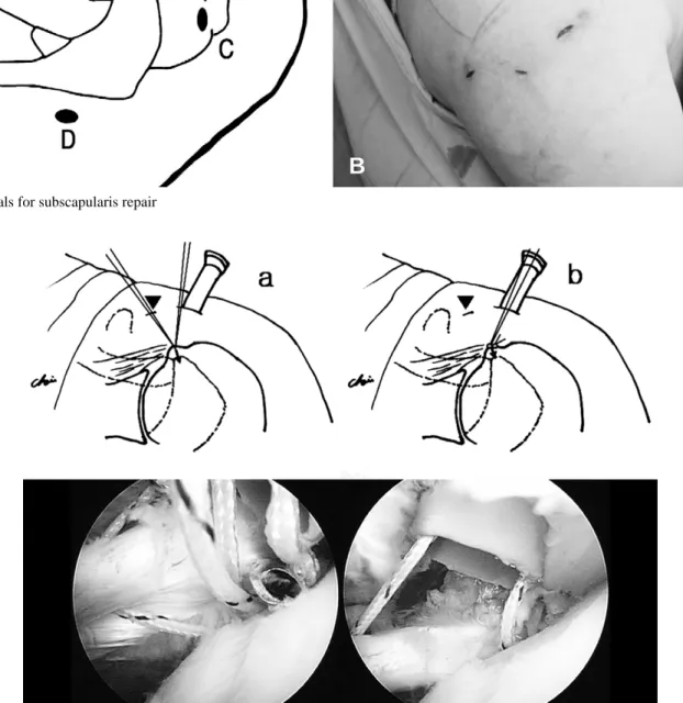Fig. 3. Portals for subscapularis repair
