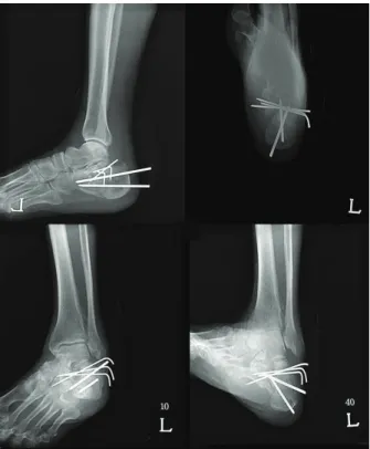 Figure  2.  Postoperative    lateral,  calcaneus  axial,  Broden’s  view  radio- radio-graph  shows  after  open  reduction  and  internal  fixation  with  K-wires  and  Steinmann  pins.