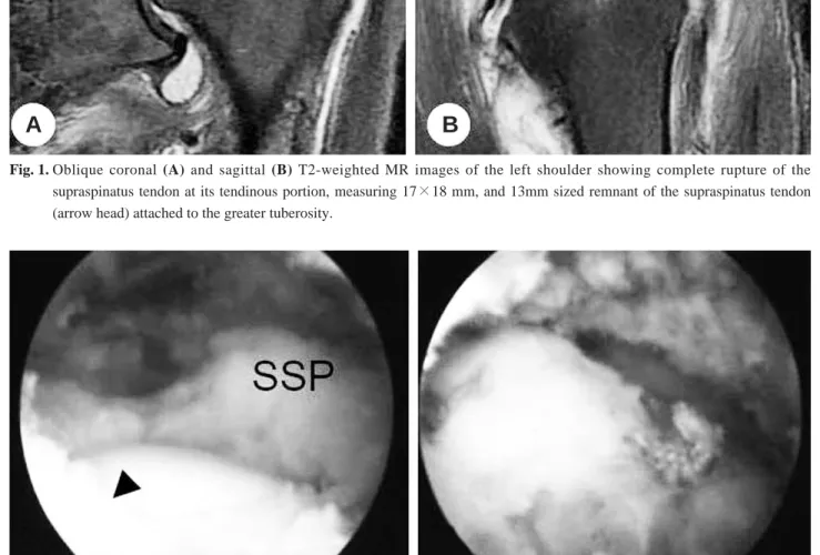 Fig. 2. (A) Arthroscopic image of the right shoulder from the rear viewing portal demonstrating a complete supraspinatus tear (SSP) and its remnant attached to the greater tuberosity (arrow head)