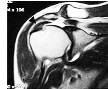Fig. 3. Oblique coronal T2-weighted MR image at 6 months after arthroscopic repair showing re-tear of the supraspinatus tendon at the previous tear site.