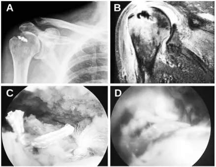 Fig. 1. (A) Preoperative plain radiograph revealed bony destruction in the suture anchor insertion portion between humeral head and greater tuberosity