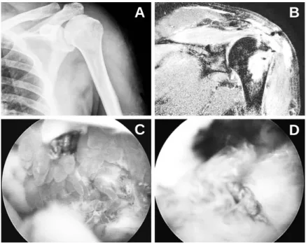 Fig. 2. (A) Preoperative plain radiograph revealed non-specific findings, otherwise sclerosis on greater tuberosity