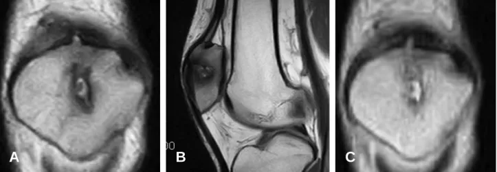 Fig. 6. After healing, residual sclerosis is observed in the patella.