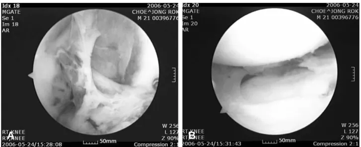 Fig. 4. Arthroscopic views show (A) inflamed synovium and fibrinous apposition in the condylar notch, however, (B) no evidence of destruction in the grafted meniscus.