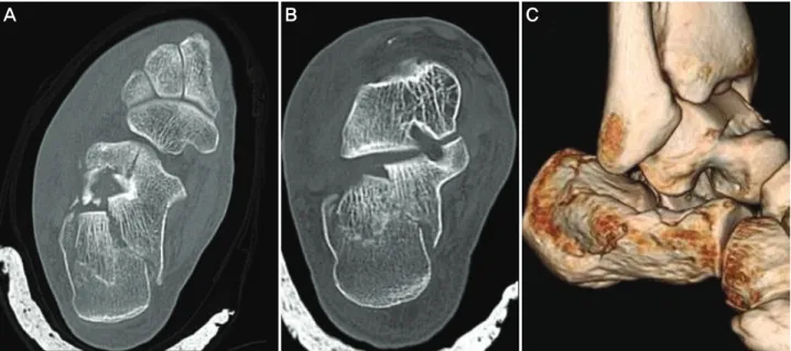 Figure  1.  Pre-operative  CT  scanning  of  the  calcaneus.  (A)  Axial  view.  (B)  Semicoronal  view