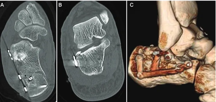 Figure  2.  Post-operative  CT  scanning  of  the  calcaneus.  (A)  Axial  view.  (B)  Semicoronal  view