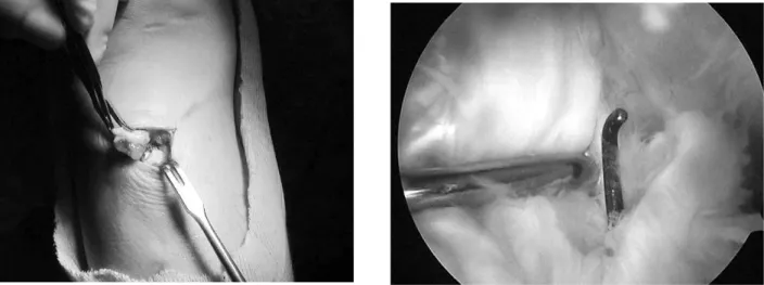 Fig. 4. The pretibial cyst is removed from the tibial attachment and has a communication with the knee joint fluid.