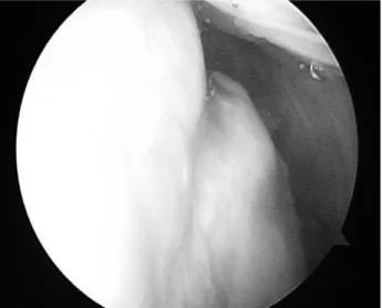 Fig. 2. The damaged lateral joint capsule with irregular fraying of the hypertrophic scar is adjacent to the plate and inserted screws.