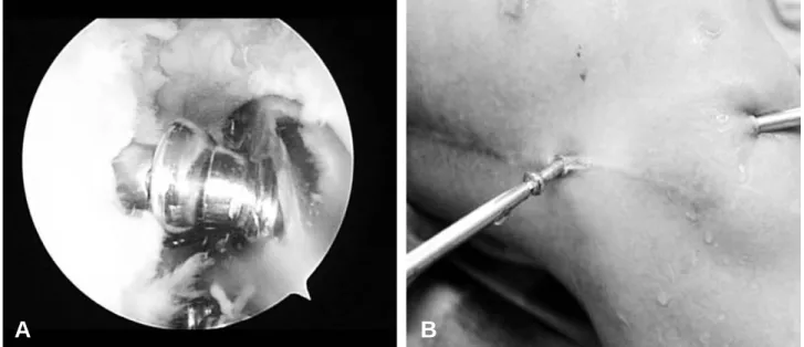 Fig. 3. Each screw within the knee joint was percutaneously removed with single small incision.