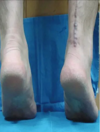 Figure  1.  (A)  Two  facial  flaps  were  twisted  180  degrees  on  them- them-selves  and  turned  distally  over  the  rupture  site