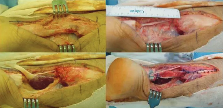 Figure  2.  Turn  down  flap  with  flexor  hallucis  longus  tendon  transfer.  M/66,  cause  of  injury  (mountain  climbing),  time  to  surgery  (75  weeks),  gap  (7  cm),  AOFAS  score  (preop  37→postop  95),  VAS  (preop  4→postop  0).