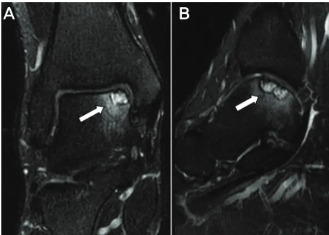 Figure  1.  (A)  Coronal  T2-weighted  image  shows  an  osteochondral  lesion  along  the  medial  aspect  of  the  talar  dome