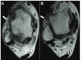 Figure  2.  Peroneal  tenosynovitis.  MR  imaging  demonstrate  significant  fluid  within  the  joined  tendon  sheath.