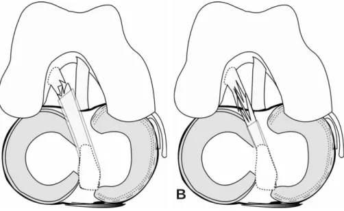 Fig. 1. The patients were divided into 2 groups according to the location of tear which was defined with the location of remained syn- syn-ovial sleeve