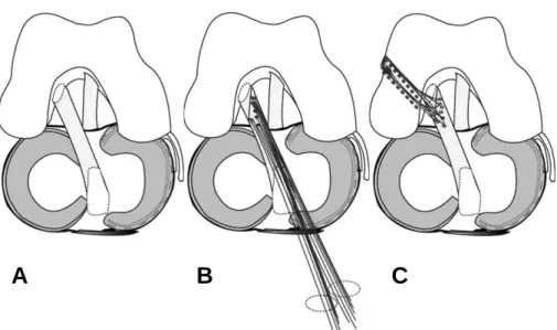 Fig. 2. Schematic drawings show normal ACL and procedures of the arthroscopic ACL primary repair