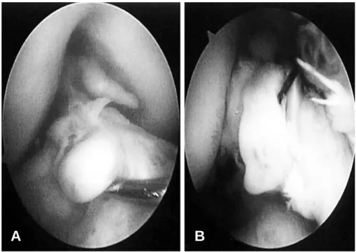 Fig. 3. The preoperative (A) and postoperative (B) arthroscopic findings of the torn ACL