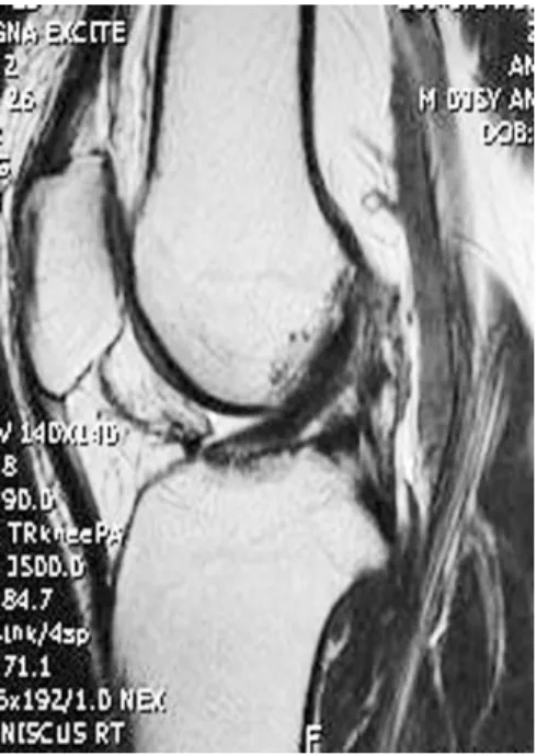 Fig. 5. Postoperative follow-up MR imaging of a 54-year-old man in group II obtained at 60 months after surgery.