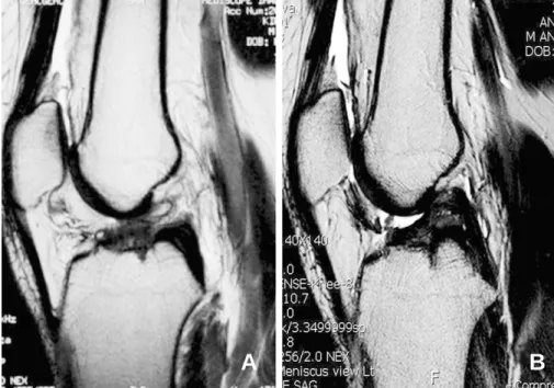 Fig. 7. Preoperative  (A) and postoperative follow-up MR imaging (B) of a 54-year-old man in group II obtained at 1 year after surgery