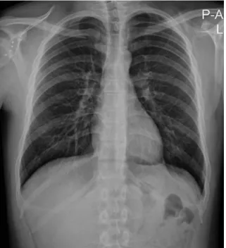 Fig. 1. Right scapula migrated upward and inward in plain X-ray.