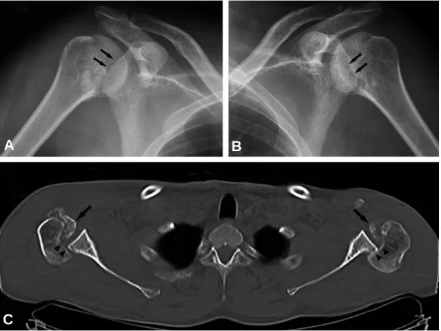 Fig. 1. Thirty-seven year-old male was diagnosed with bilateral locked posterior dislocation of the shoulder by sim- sim-ple radiographs and computed tomography scan
