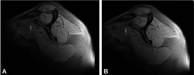 Fig. 1. Preoperative measurements of atrophy of rotator cuff (A) The most lateral image on which the scapular spine is in contact with the rest of the scapula was chosen as reference section