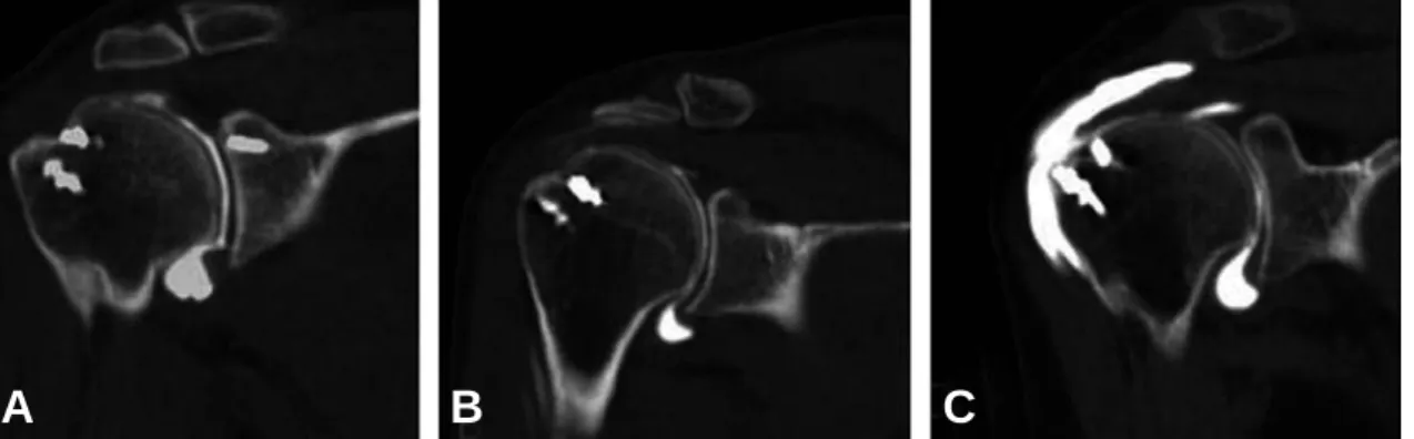 Fig. 2. Evaluation of cuff integrity by 1-year post-operative computed tomography arthrogrphy (A) 1-year post-oper- post-oper-ative computed tomography arthrography shows intact repaired rotator cuff