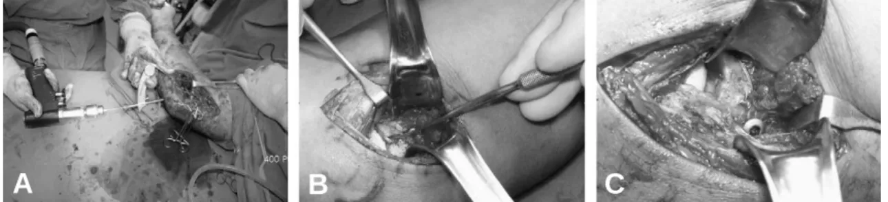 Fig. 1. (A) ACL guide used for targeting the K-wire to the coronoid process fragment. (B, C) Coronoid process frag- frag-ment was fixed to the base with tension band technique using unicorical screw, k- wire and wire